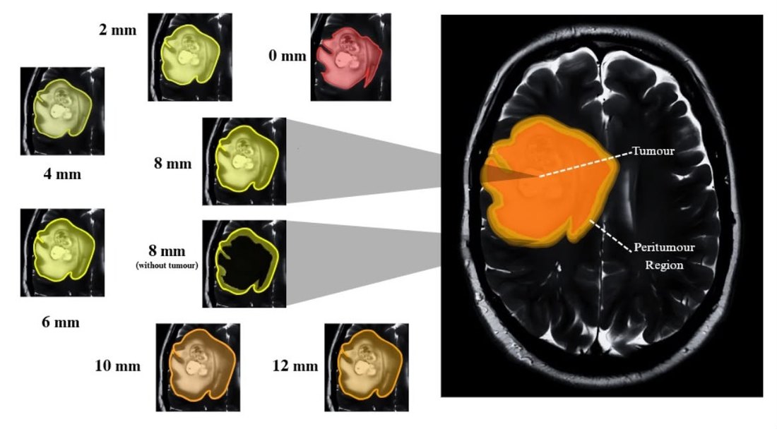 Progressively dilated peritumoral regions from 0 to 12 mm around a glioblastoma on T2 MRI, with tumour and peritumour regions annotated